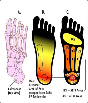 plantar fascitis