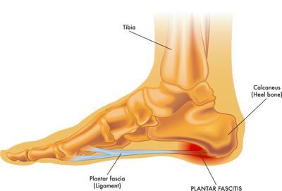 plantar fasciitis capitola